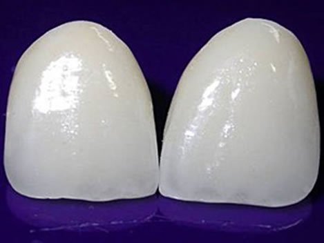 'Lente de contato' para dente corrige imperfeies e evita desgaste