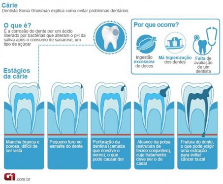 Redobrar os cuidados com a higiene bucal noturna ajuda a prevenir cries