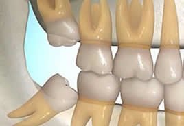 Remoo do siso evita que os outros dentes encavalem e previne infeces