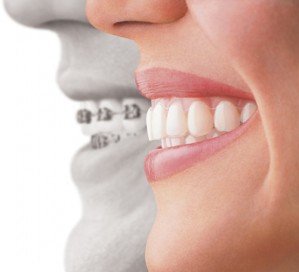 Tratamento com aparelho nos dentes melhora a auto-estima e a sade